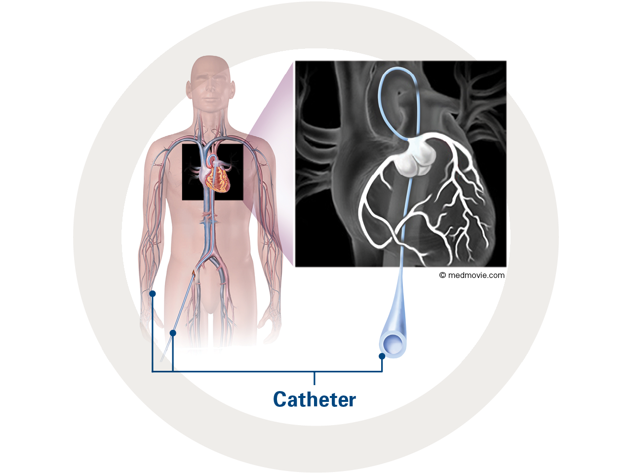 Complex PCI Download Center Boston Scientific